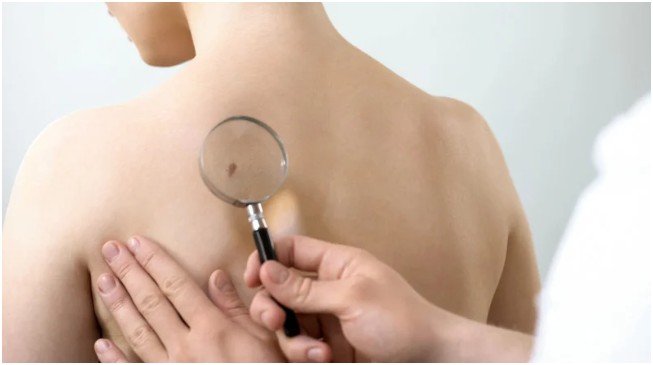 The Necessity of Skin Checks in Melbourne