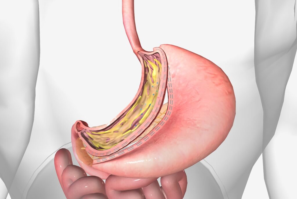 Long-Term Outcomes of Gastric Sleeve Surgery