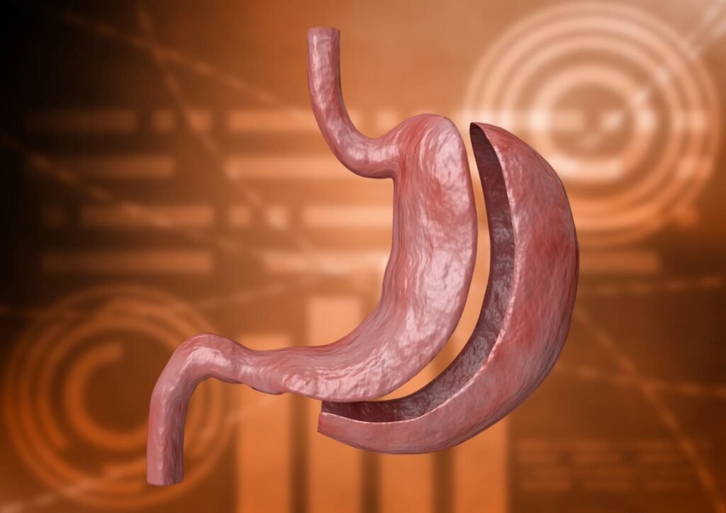 An Overview of Gastric Sleeve Surgery